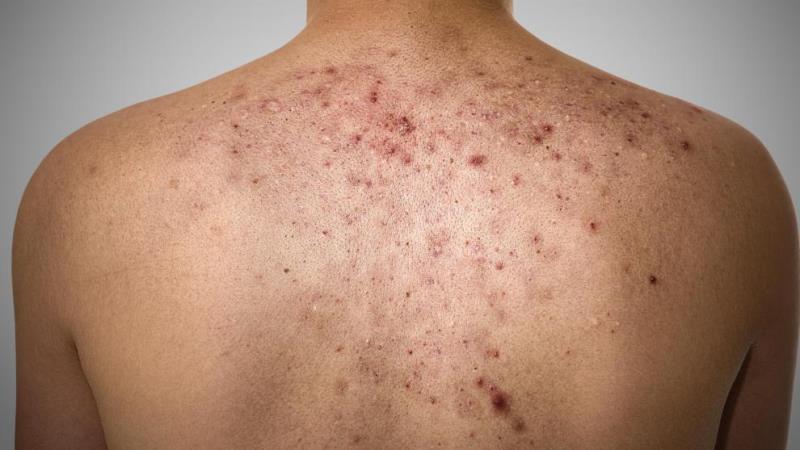How To Get Rid Of Acne On Your Back – 6 Curing Tips