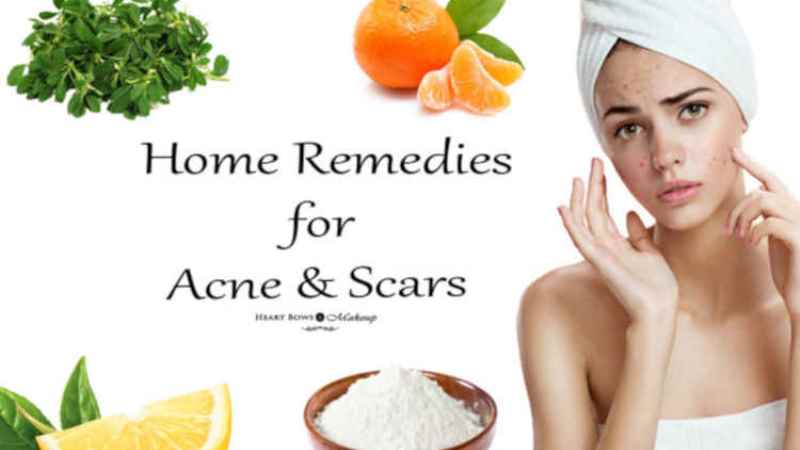 Home Remedies To Get Rid Of Acne – 10 Natural Acne Curing Tips